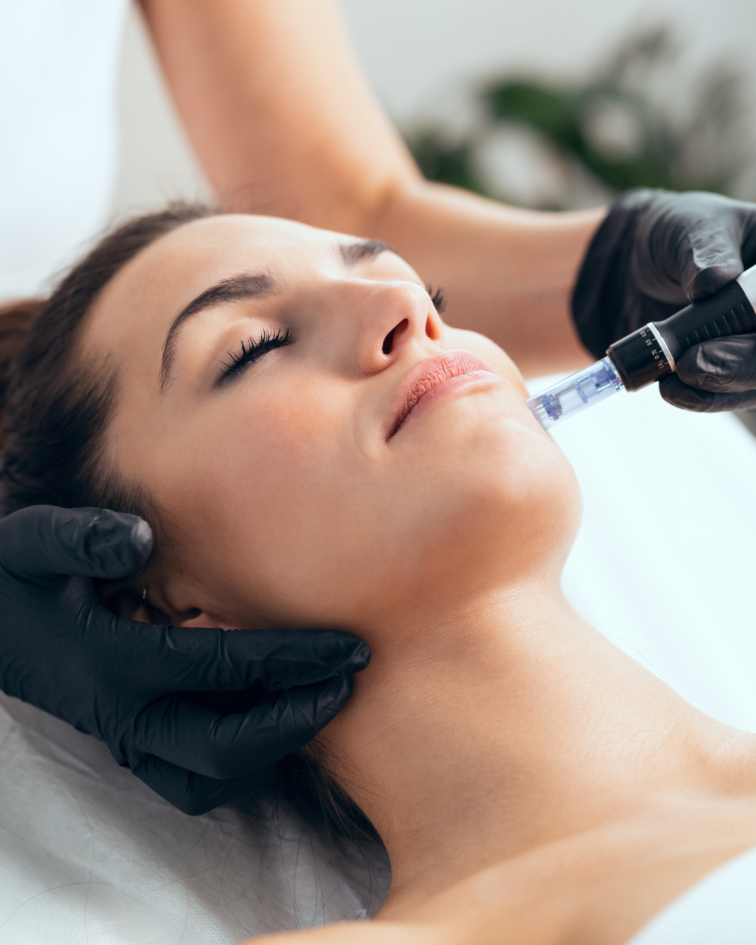dermapen vall d'uixo