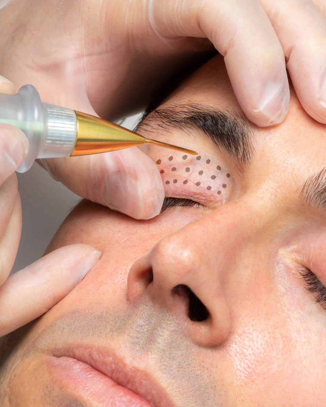 PLASMA PEN y FIBROBLAST vives clinic