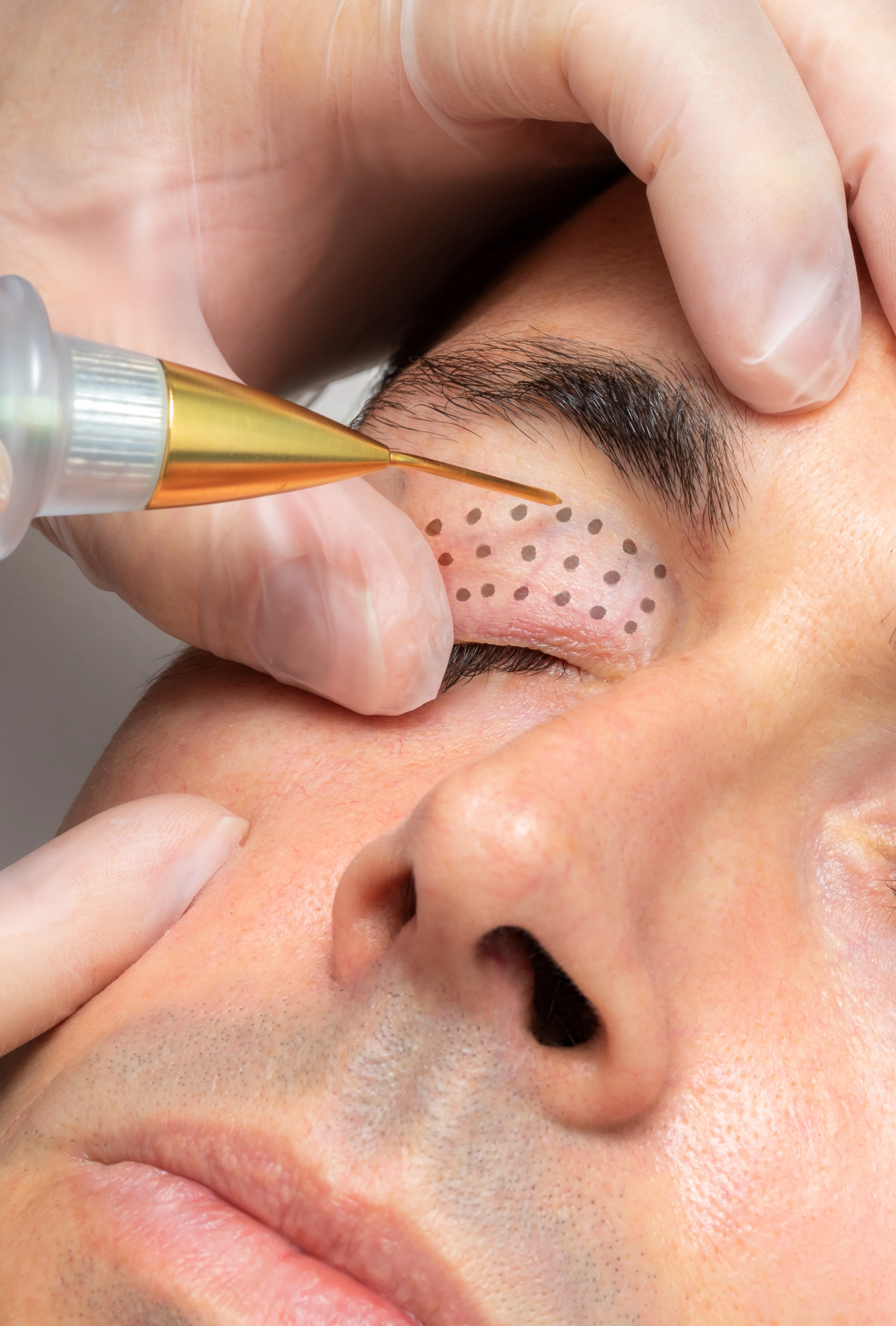PLASMA PEN y FIBROBLAST vives clinic